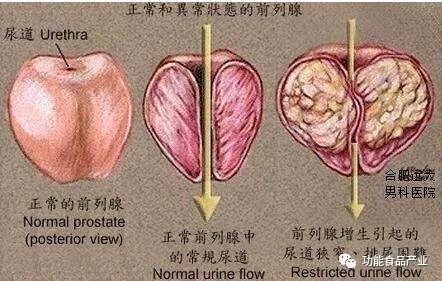 前列腺炎最新研究成果概览