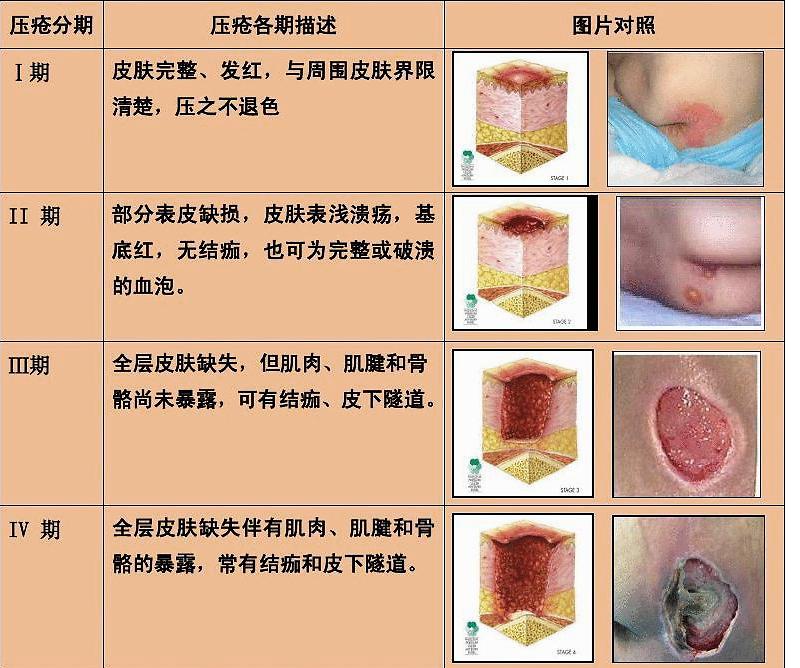 最新压疮分期与护理要点简介